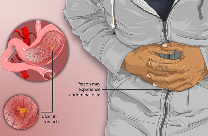 Homeopathy Doctors for Peptic Ulcer in Pammal