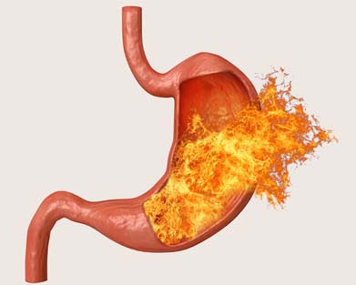 Ulcer Treatment in Homeopathy in Pammal